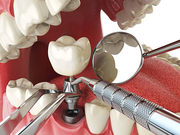 Best Dental Abscess Treatment in Meraux, LA